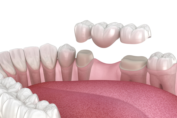 What To Expect Before, During, And After Dental Bridge Placement