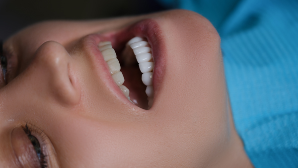 The Benefits Of Dental Veneers